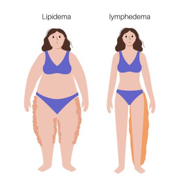 Lenf kanseri ve lipedema hastalığı konsepti. Dişi bacakları şişmiş. İnsan obezitesindeki lenf düğümleri zarar görmüş. Aşırı kilo sorunu ve fil asidi. Lenfatik sistem düz vektör illüstrasyonunda bozukluk