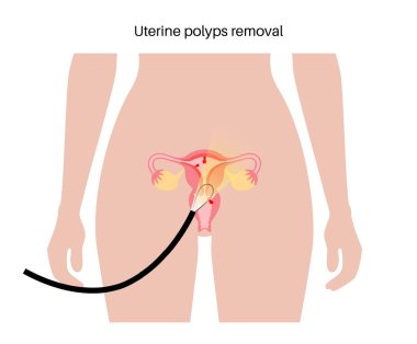 Uterine polyps removal. Endometrial disease. Overgrowth of cells in the uterus and endometrium. Woman health concept. Cause of irregular menstrual bleeding and infertility flat vector illustration. clipart