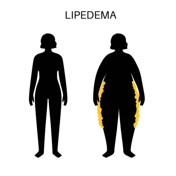 Lipedema Hastalığı Konsepti Kadın Vücudunun Aşık Kısmında Yağ Birikiyor Kalça — Stok Vektör