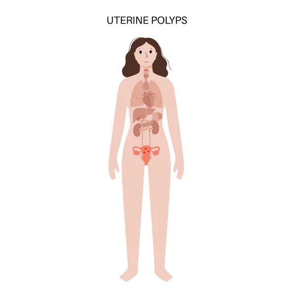 Rahim Polipleri Anatomisi Endometriyal Hastalık Rahim Endometriyumdaki Hücrelerin Aşırı Büyümesi — Stok Vektör