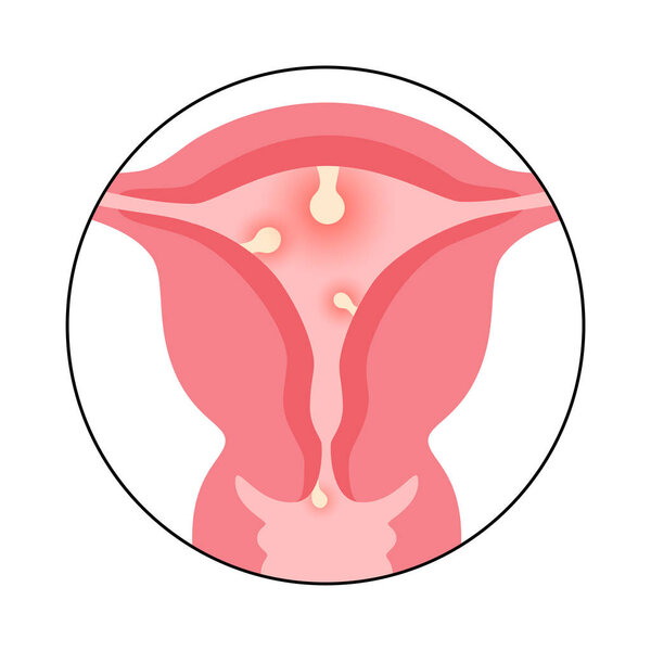 Uterine polyps anatomy. Endometrial disease. Overgrowth of cells in the uterus and endometrium. Woman health concept. Cause of irregular menstrual bleeding and infertility flat vector illustration.