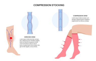 Sıkıştırma çorabı konsepti. Varisli damarlarda basınç sorunları var. Yetersiz venöz için özel fitness çorapları. Ameliyat kıyafetleri. Sağlıklı ince kadın ayak vektör çizimi.