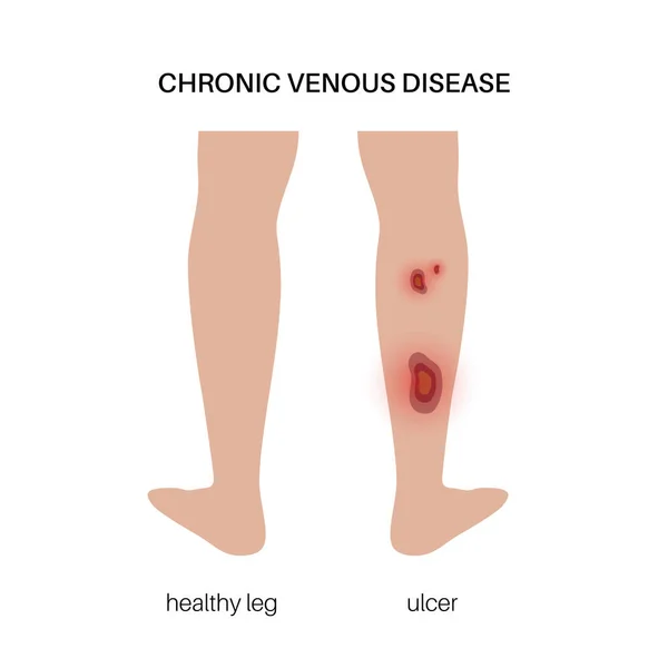 Concept Blessure Aux Jambes Ulcère Trophique Cloques Plaies Sur Corps — Image vectorielle