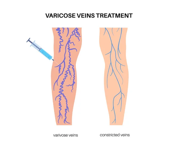 Sclerotherapie Chirurgie Spataderen Spinnen Behandeling Medische Procedure Injecteren Van Een — Stockvector