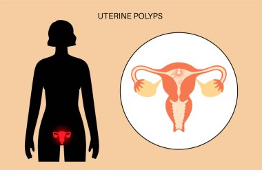 Rahim polipleri anatomisi. Endometriyal hastalık. Rahim ve endometriyumdaki hücrelerin aşırı büyümesi. Kadın sağlığı konsepti. Düzensiz adet kanaması ve kısırlık düz vektör çizimi.