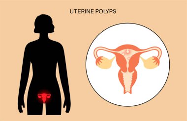 Uterine polyps anatomy. Endometrial disease. Overgrowth of cells in the uterus and endometrium. Woman health concept. Cause of irregular menstrual bleeding and infertility flat vector illustration. clipart