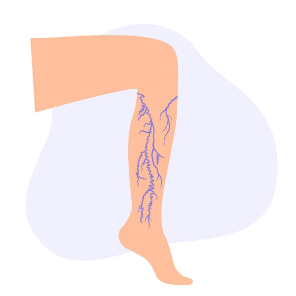 Варикозное Расширение Вен Опухоль Боль Женских Ногах Диагностика Лечение Сосудистых — стоковый вектор