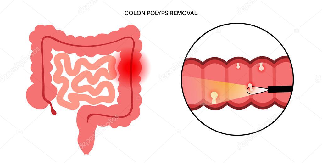 Colon polyps removal. Hyperplastic, inflammatory and hamartomatous polyp. Development of tumor in large intestine. Pain and inflammation in human body. Internal organs exam flat vector illustration.