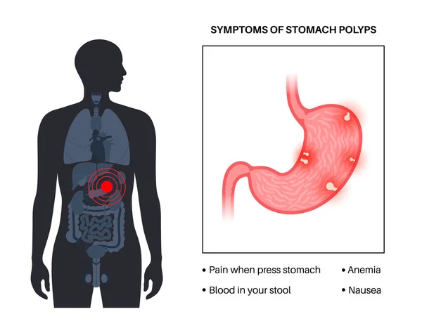 診断と診療所での除去をポリープ 内視鏡手順の概念 ヒト内部器官における細胞の成長 胃の問題 男性のシルエットフラットベクトルイラストの消化管 — ストックベクタ
