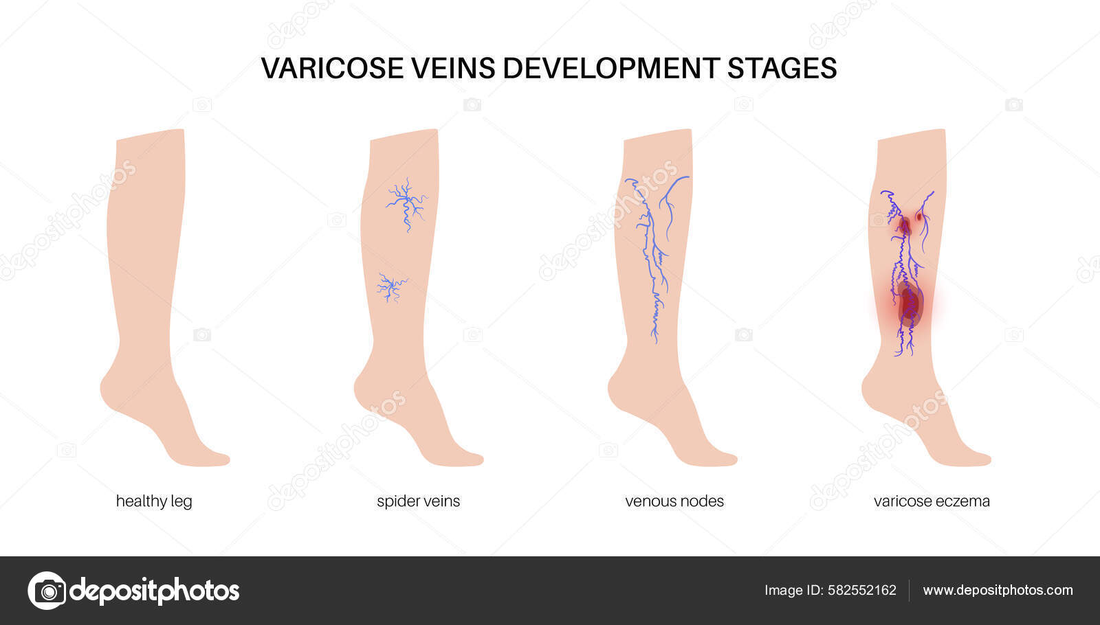 Varicose Veins Concept Swelling Pain Human Legs Vascular Disease