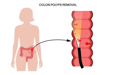 Kolon polipsi konsepti. Hiperplastik, iltihap ve hemartomatoz polip. İnce bağırsaklarda tümör gelişti. İnsan vücudunda acı ve iltihap. İç organlar sınav düz vektör çizimi.