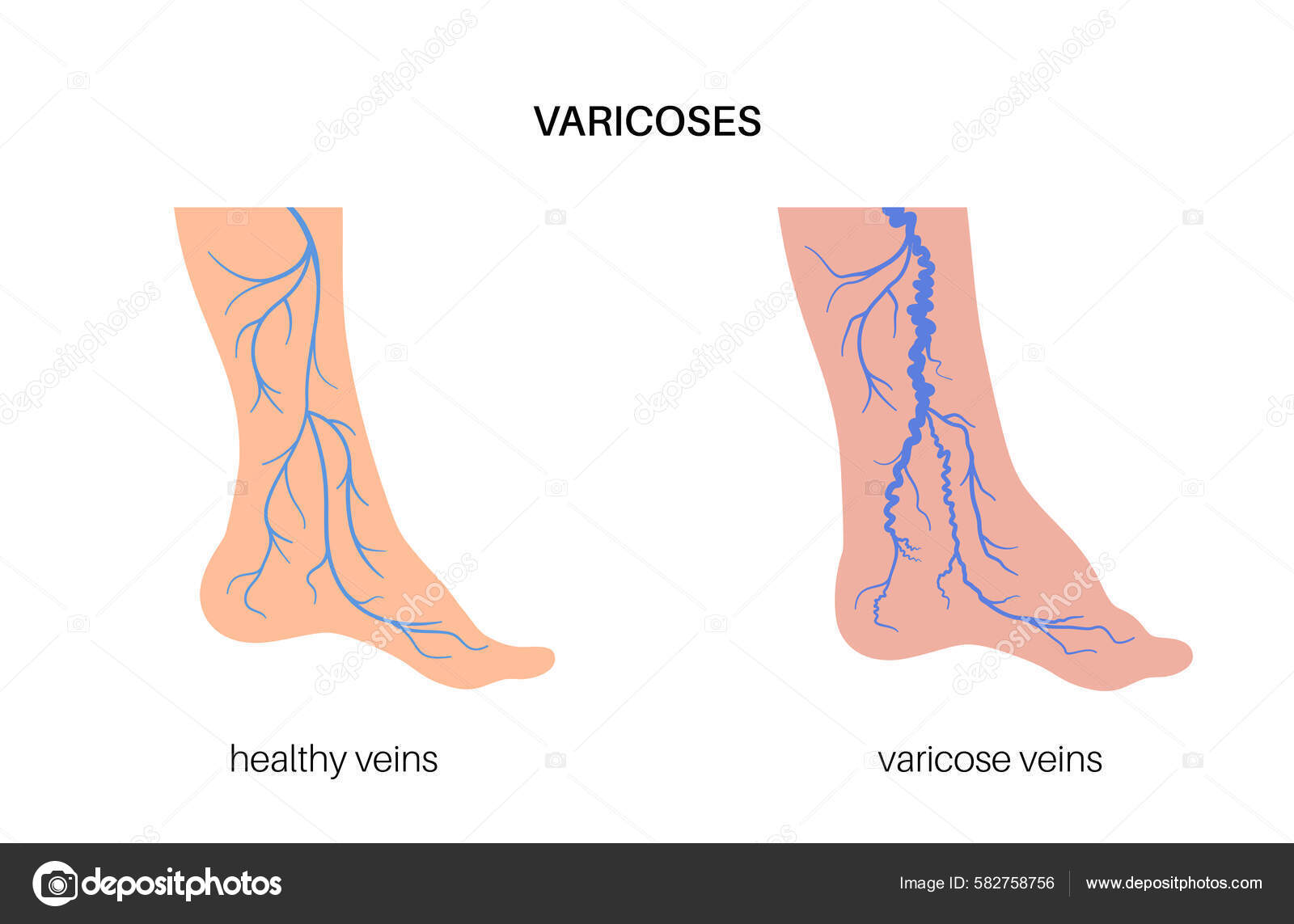 Edema Varicose Veins Swelling Pain Human Legs Vascular Disease