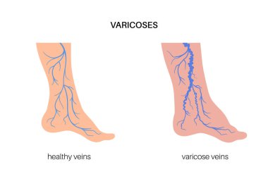 Ödem ve varis. Şişkinlik ve insan bacağında ağrı. Vasküler hastalık teşhisi ve tedavisi. Anormal kan basıncı, zayıf damar ve kapakçıklar. Venöz yetersizlik tıbbi vektör çizimi