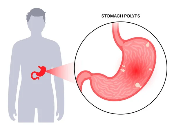 Gyomorpolip Diagnosztika Eltávolítás Klinikán Endoszkópos Eljárás Koncepciója Sejtek Növekedése Emberi — Stock Vector