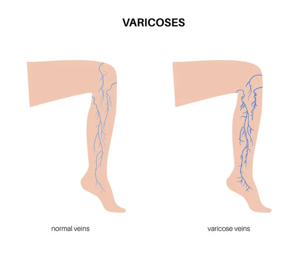 Spataderen Concept Zwelling Pijn Vrouwelijke Benen Diagnose Behandeling Van Vaatziekten — Stockvector