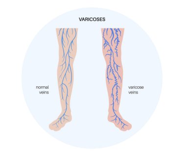 Varis damar konsepti. Şişkinlik ve insan bacağında ağrı. Vasküler hastalık teşhisi ve tedavisi. Anormal kan basıncı, zayıf damar ve kapakçıklar. Venöz yetersiz tıbbi düz vektör çizimi