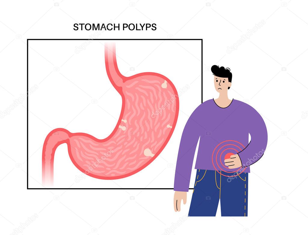 Stomach polyps diagnostic and removal in clinic. Endoscopy procedure concept. Growth of cells in human internal organs. Gastric problems, digestive tract in male silhouette flat vector illustration