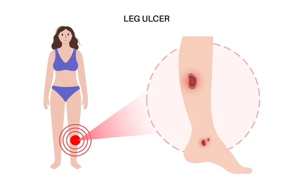 Bacak Yarası Konsepti Trofik Ülser Insan Vücudunda Kabarcıklar Yaralar Kadın — Stok Vektör