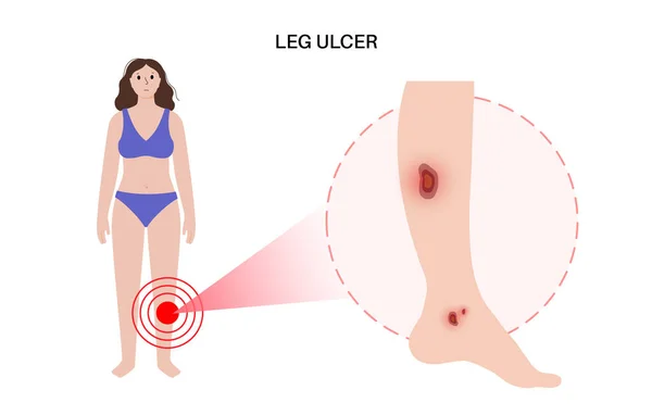 脚の創傷コンセプト 熱帯性潰瘍 ヒトの体内の水疱や痛み 女性の足での静脈瘤の病期 皮膚科医ポスターフラットベクトル白の背景に孤立イラスト — ストックベクタ