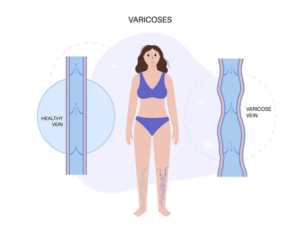 Varicose Vener Koncept Svullnad Och Smärta Mänskliga Ben Diagnos Och — Stock vektor