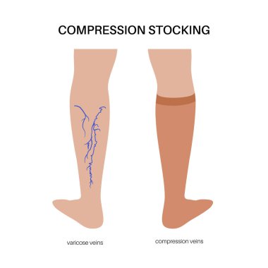 Sıkıştırma çorabı konsepti. Varisli damarlarda basınç sorunları var. Yetersiz venöz için özel fitness çorapları. Ameliyat kıyafetleri. Sağlıklı ince kadın ayak vektör çizimi.
