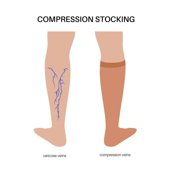 Compression Stocking Concept Pressure Problems Varicose Veins Special Fitness Socks — Stock Vector