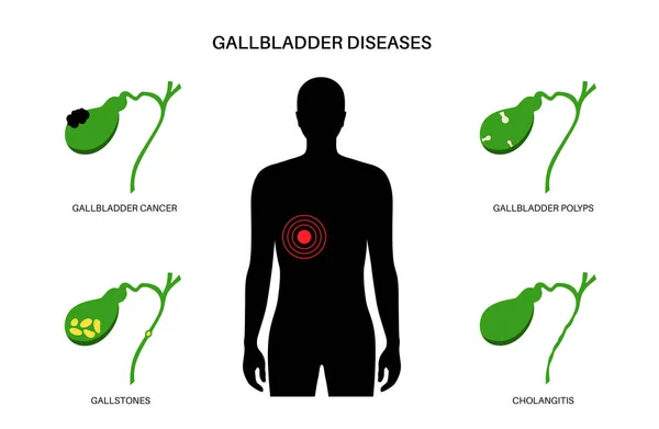 Gallbladder Diseases Infographic Gallstone Cancer Acute Cholecystitis Psc Polyps Digestive — Stock Vector