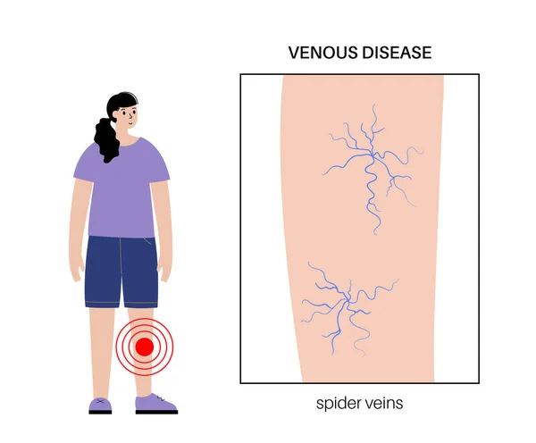 Varis Damar Konsepti Şişkinlik Insan Bacağında Ağrı Vasküler Hastalık Teşhisi — Stok Vektör