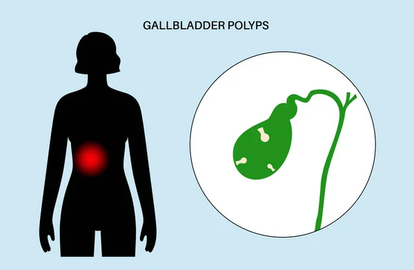Gallbladder Polyps Concept Inflammation Digestive System Human Internal Organ Examination — ストックベクタ