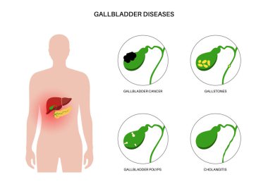 Gallbladder diseases infographic. Gallstone, cancer, acute cholecystitis, PSC or polyps the digestive system. Biliary ducts problems. Common cause of abdomen inflammation, flat vector illustration. clipart