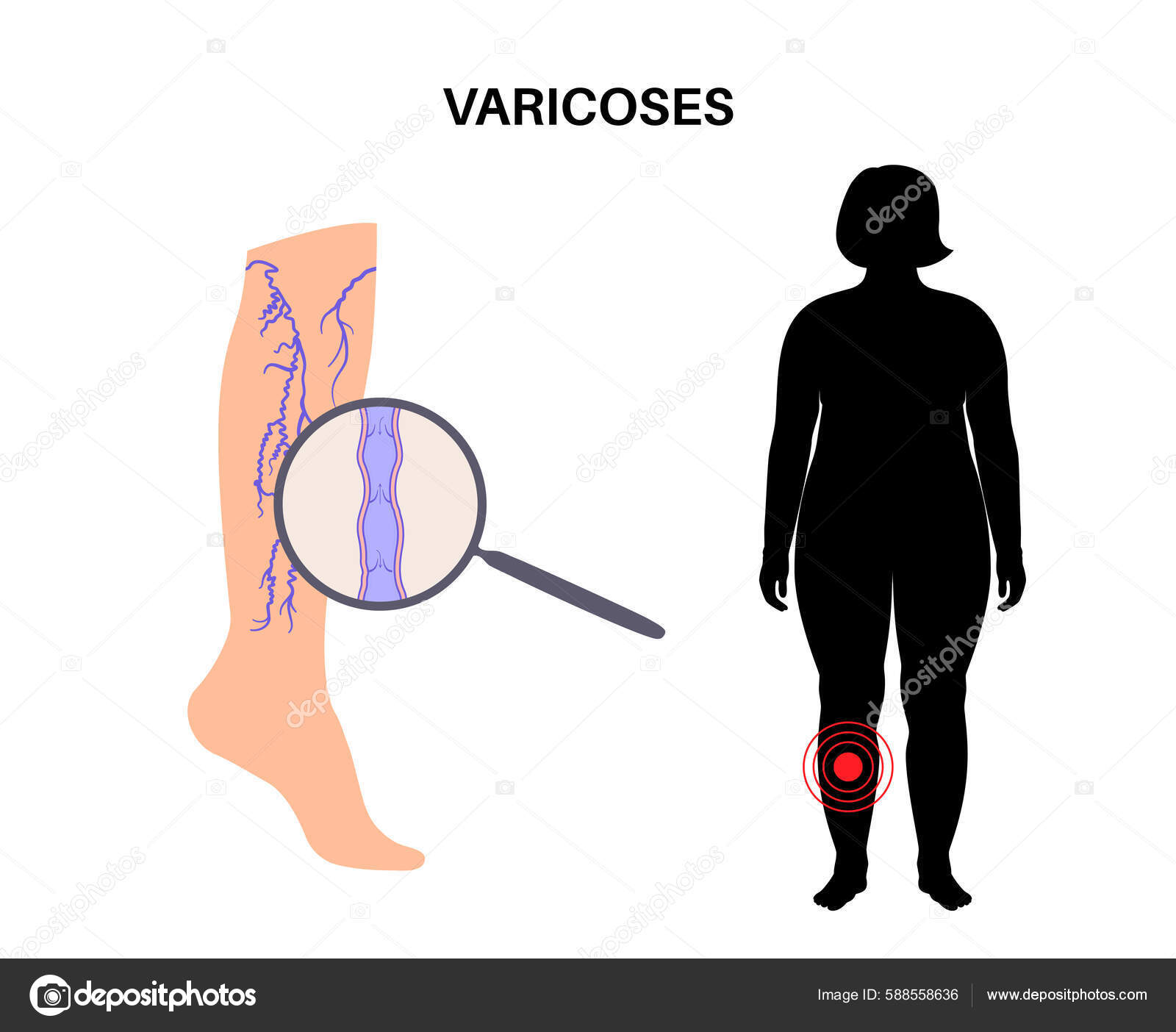 Varicose Veins Concept Swelling Pain Human Legs Vascular Disease