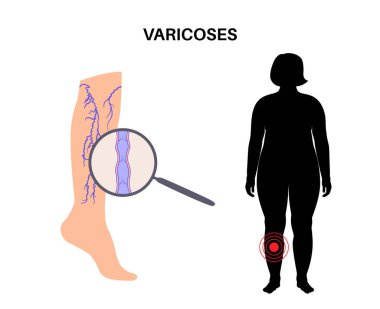 Varis damar konsepti. Şişkinlik ve insan bacağında ağrı. Vasküler hastalık teşhisi ve tedavisi. Anormal kan basıncı, zayıf damar ve kapakçıklar. Venöz yetersiz tıbbi düz vektör çizimi