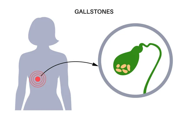 Gallstones Human Body Stones Gallbladder Inflammation Digestive System Abdomen Pain — ストックベクタ