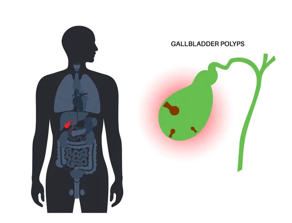 Concept Polypes Vésicaux Biliaires Inflammation Dans Système Digestif Examen Des — Image vectorielle