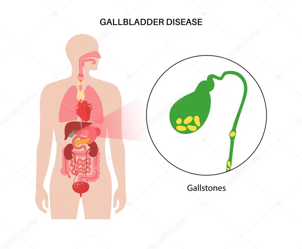 Gallstones in the human body. Stones in the gallbladder, inflammation in the digestive system and abdomen pain. Human internal organ examination in clinic or hospital. Medical flat vector illustration