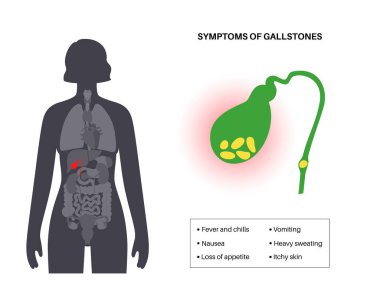 Main gallstones symptoms. Nausea, vomiting, loss of appetite, fever and diarrhea. Gallbladder stones disease treatment. Digestive system problems. Biliary duct anatomy medical vector illustration.