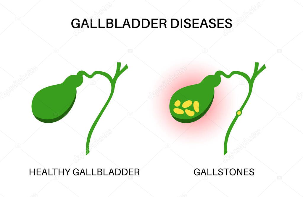 Gallstones anatomy. Inflamed and healthy internal organ. Stones in the gallbladder. Abdomen pain and digestive system problems. Human body examination in clinic or hospital flat vector illustration