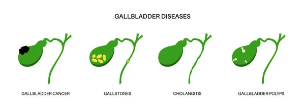 Gallbladder Diseases Infographic Gallstone Cancer Acute Cholecystitis Psc Polyps Digestive — ストックベクタ