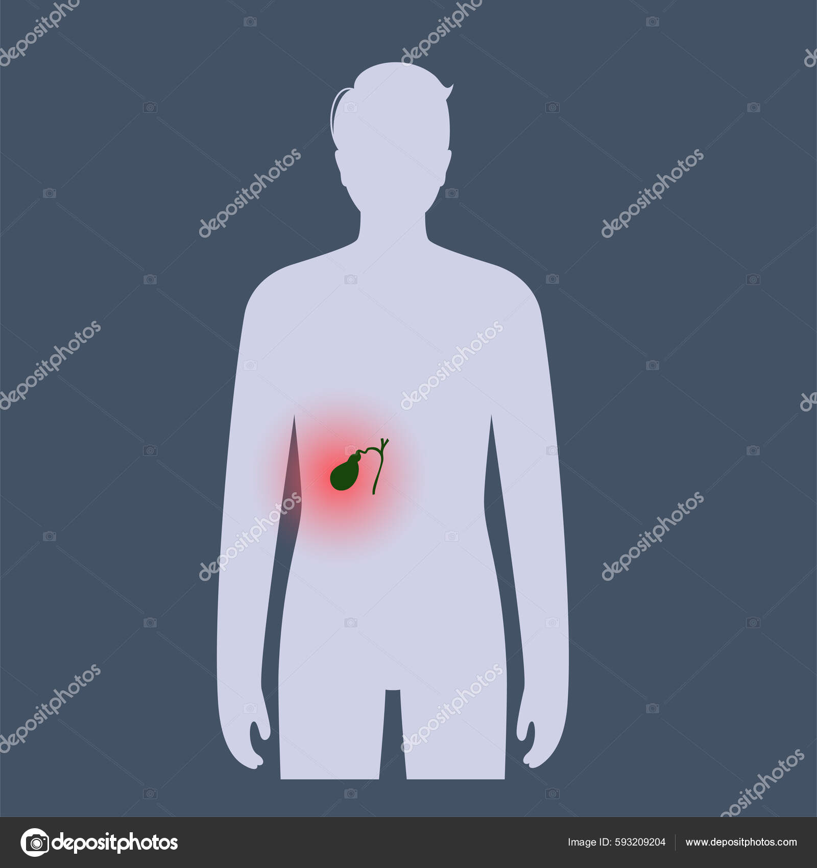 Gallbladder Diseases Infographic Gallstone Cancer Acute Cholecystitis