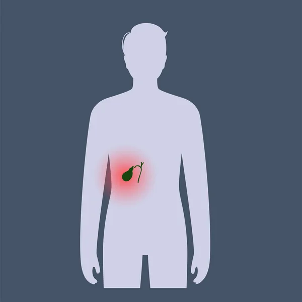 Infographie Des Maladies Vésicule Biliaire Pierre Biliaire Cancer Cholécystite Aiguë — Image vectorielle