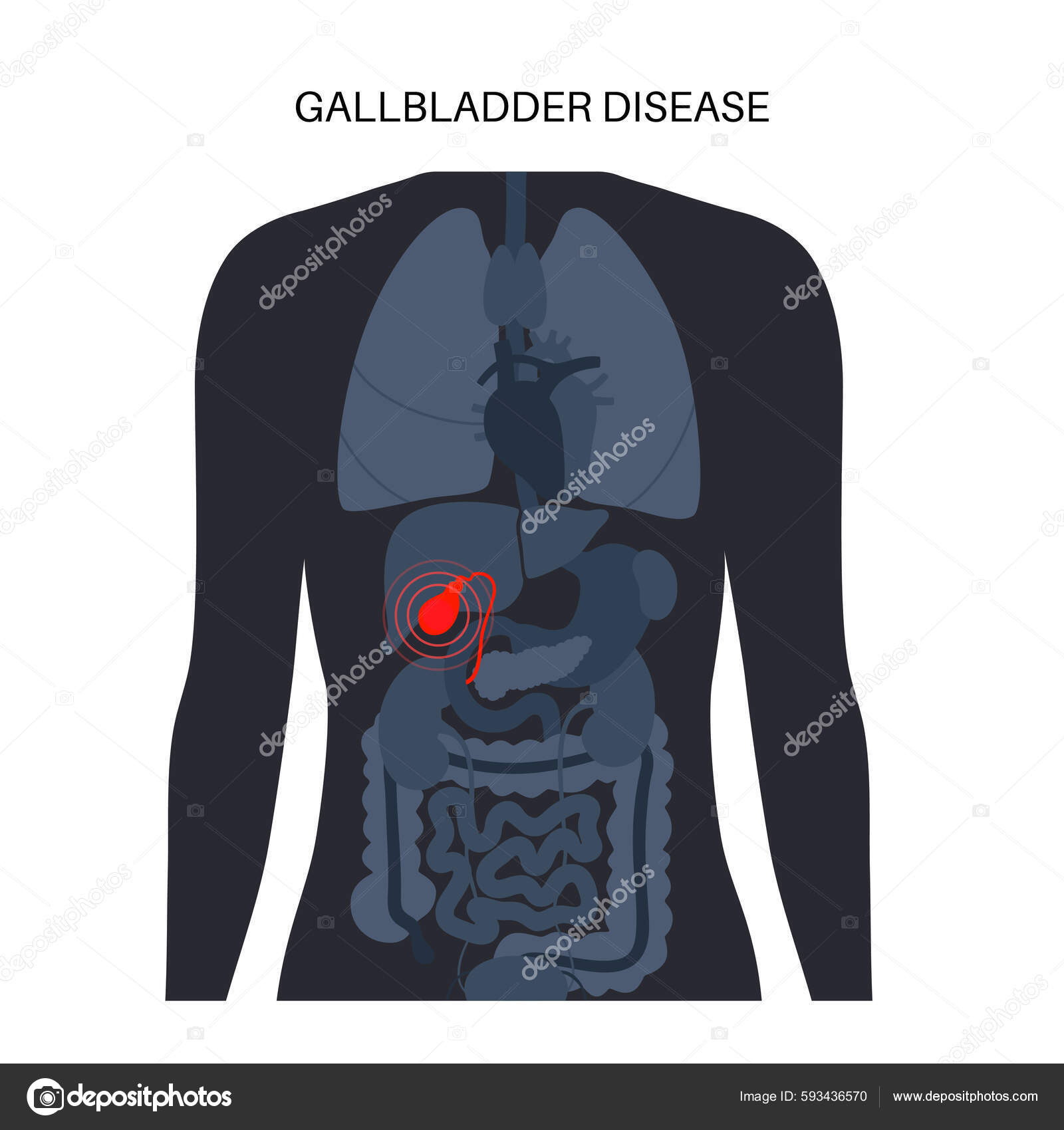 Gallbladder Diseases Infographic Gallstone Cancer Acute Cholecystitis