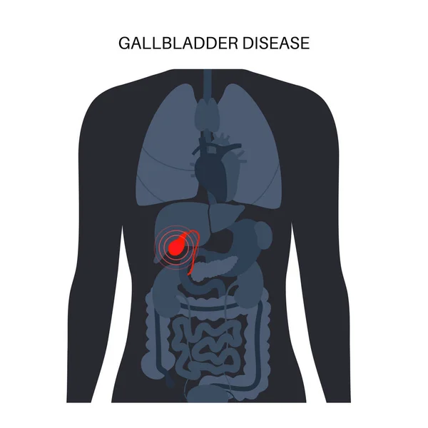 Gallbladder Diseases Infographic Gallstone Cancer Acute Cholecystitis Psc Polyps Digestive — Vettoriale Stock