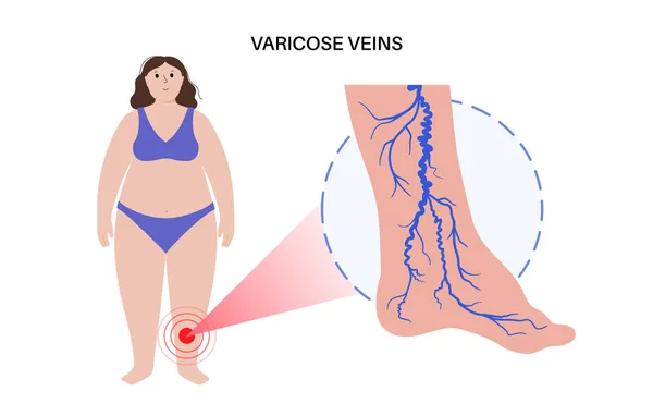 정맥의 개념이야 인간의 다리에 상처를 고통을 비정상적 의학적으로 불충분 — 스톡 벡터