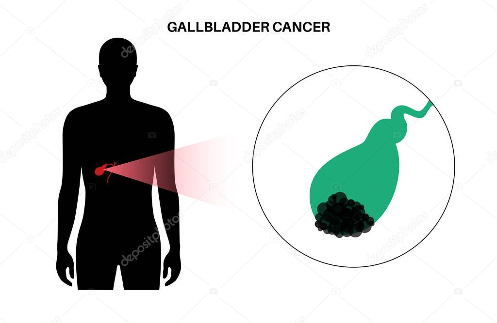 Gallbladder cancer concept. Inflammation in the digestive system and abdomen pain. Tumor cells in the human body. Internal organ examination in clinic or hospital. Medical flat vector illustration