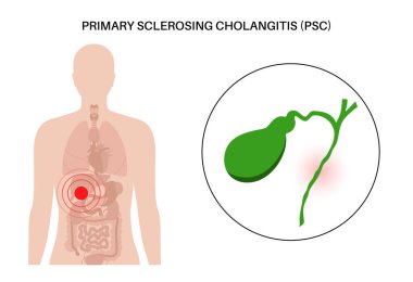Primary sclerosing cholangitis concept. PSC Gallbladder disease.Abdomen pain in the human body. Inflammation in the digestive system. Internal organ examination in clinic. Medical vector illustration.