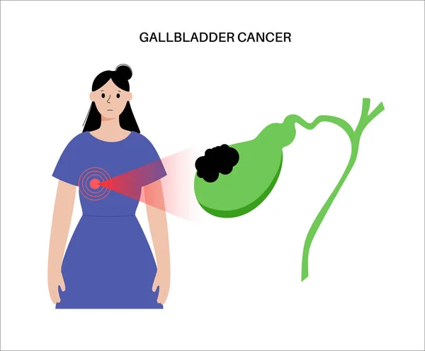 Concept Cancer Vésicule Biliaire Inflammation Système Digestif Douleurs Abdominales Cellules — Image vectorielle