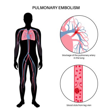 Pulmonary embolism disease. Deep vein thrombosis in male body. Blood clot in lung vein anatomical poster. Blocking blood flow in lungs. Circulatory system problem. DVT medical flat vector illustration