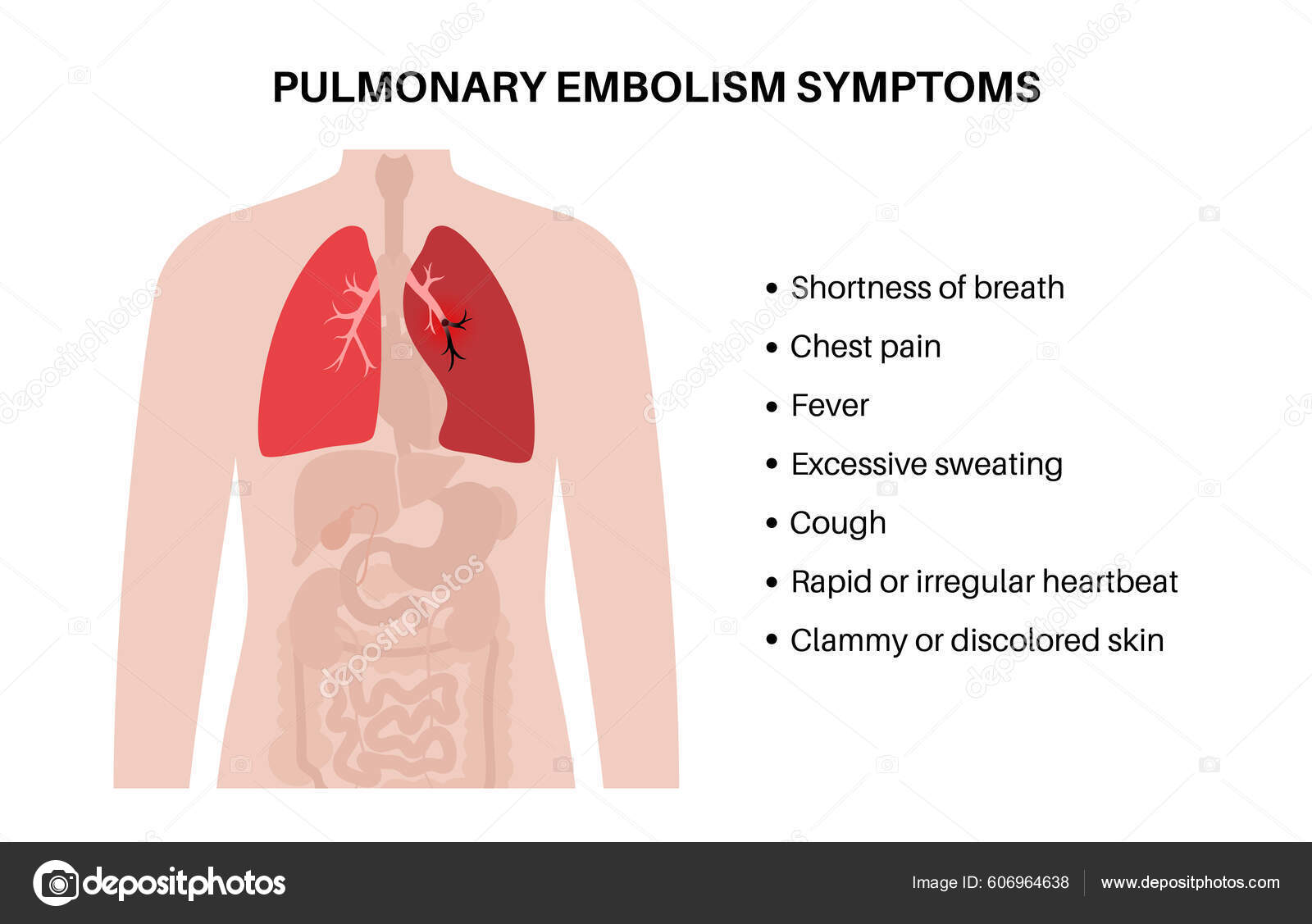 Pulmonary Embolism Symptoms Deep Vein Thrombosis Disease Blood