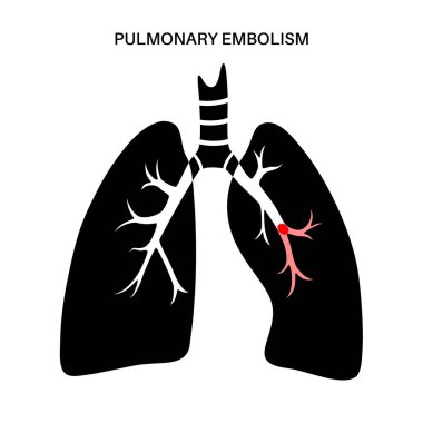 Akciğer embolisi hastalığı. Derin ven trombozu. Akciğer damarlarındaki kan pıhtısı anatomik posteri kapatıyor. Ciğerlerdeki kan akışını engelliyor. Dolaşım sistemi sorunu. DVT tıbbi düz vektör çizimi