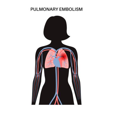 Akciğer embolisi hastalığı. Kadın vücudunda derin damar trombozu. Akciğer damar anatomik posterinde kan pıhtısı. Ciğerlerdeki kan akışını engelliyor. Dolaşım sistemi sorunu. DVT düz vektör çizimi